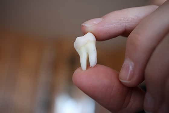 person holding an extracted wisdom tooth