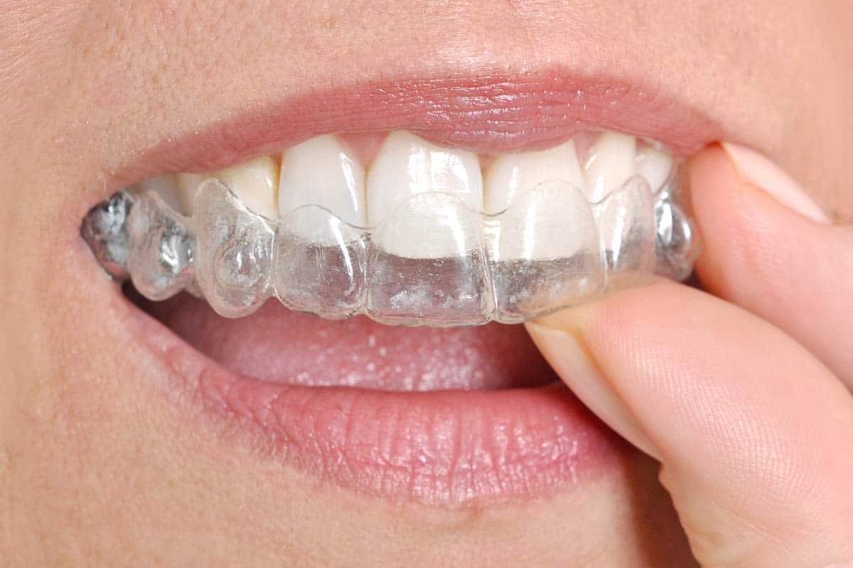 woman putting on an invisalign aligner on her upper teeth