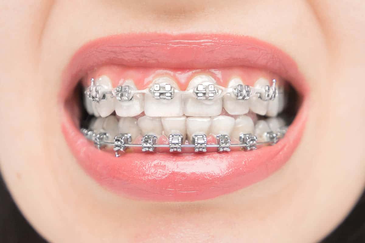 Close up photo of woman with metal dental braces. 