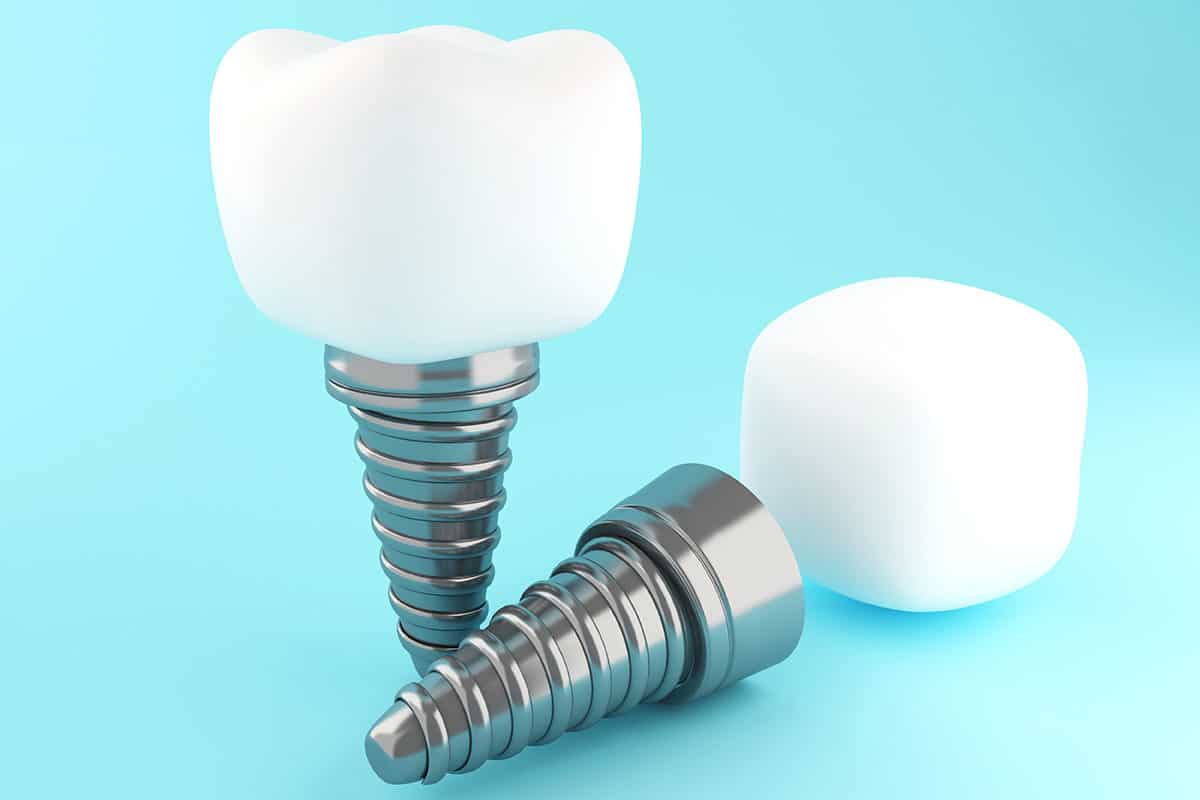 3D Illustration. Dental tooth implant