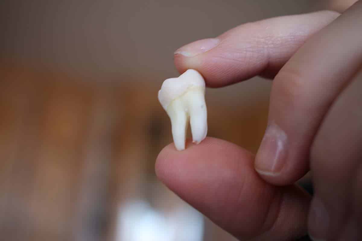 person holding extracted wisdom tooth