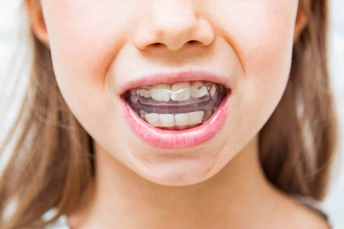 Child girl wearing clear aligners