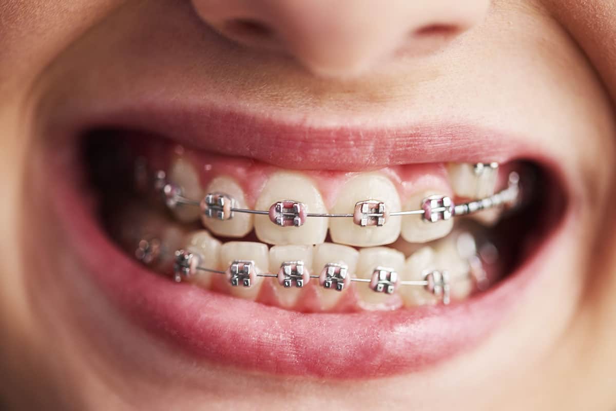 Child's teeth with braces