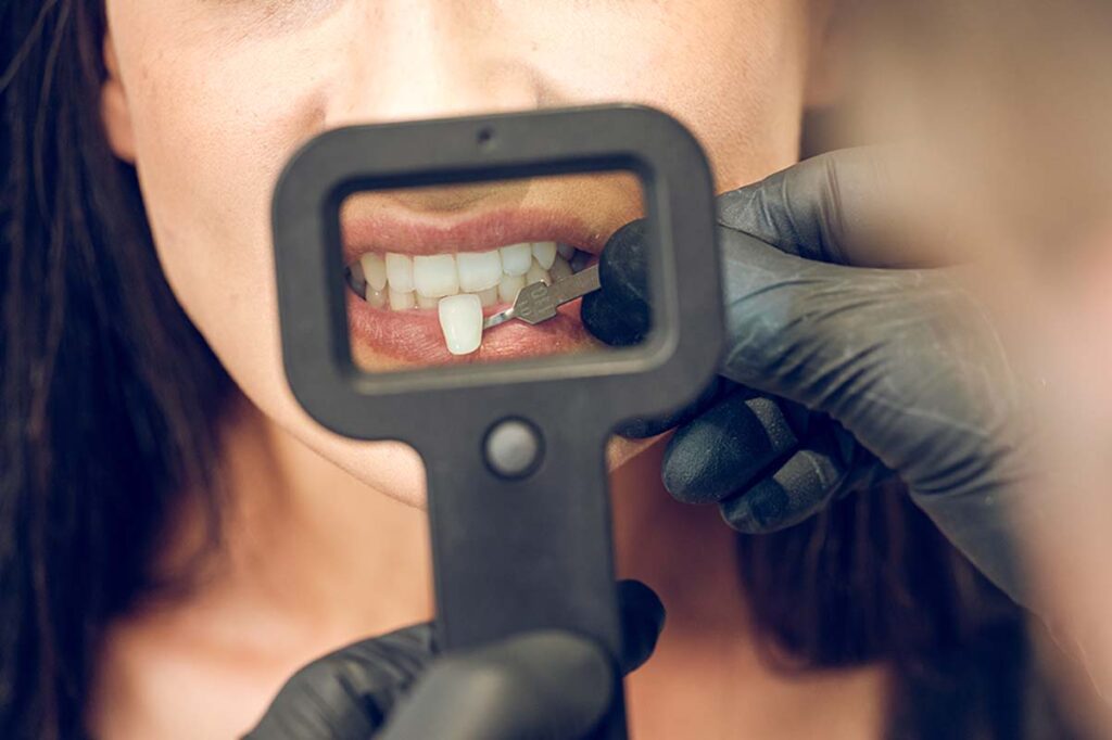 Veneers Singapore Cost, Composite, Porcelain Pristine Dentalworks