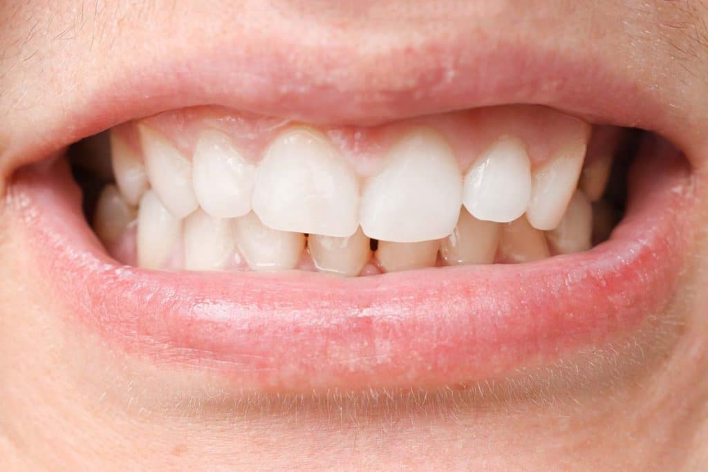 how-to-prevent-teeth-staining-pristine-dentalworks