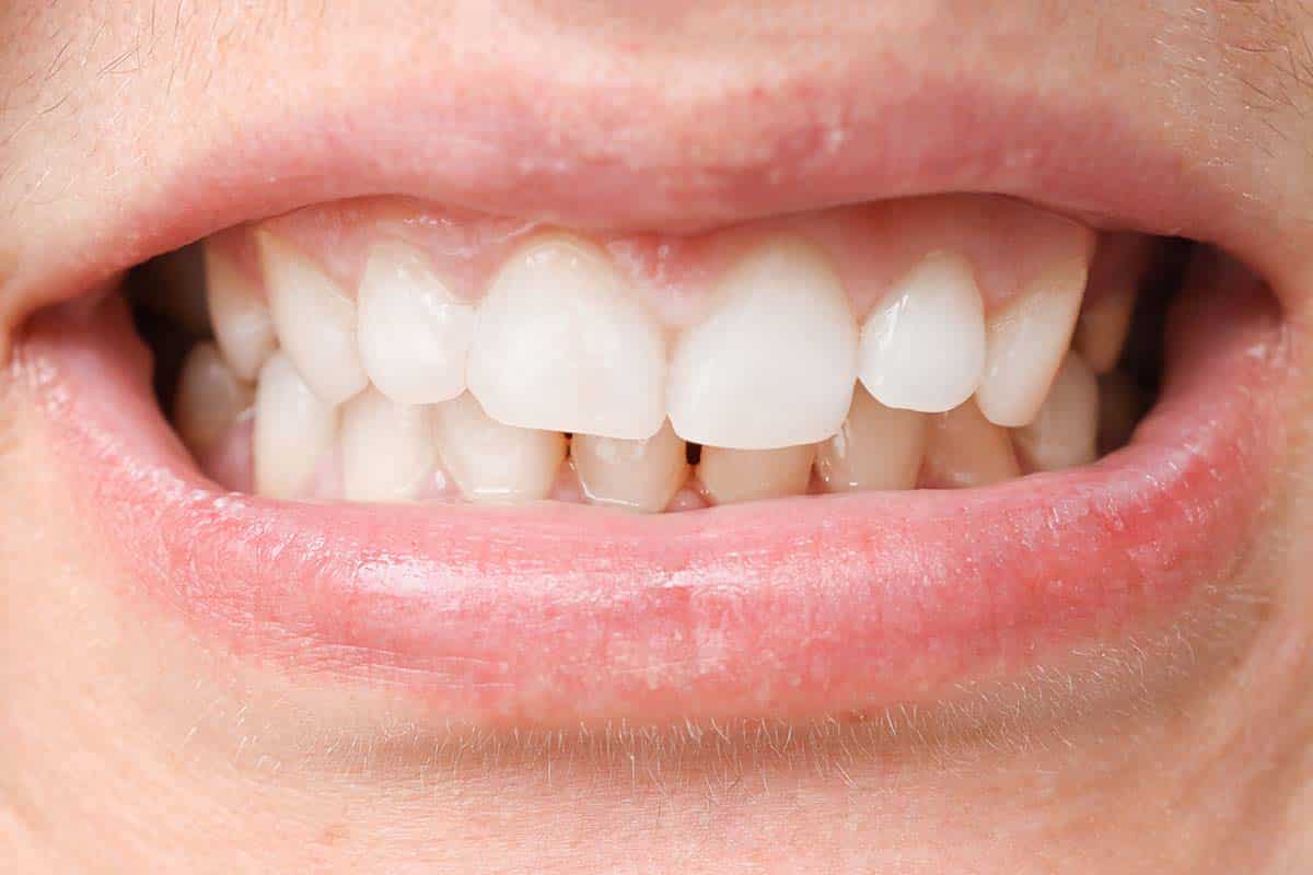 how to prevent teeth staining