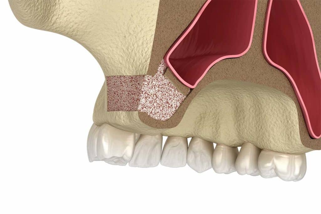 3d illustration of a bone graft with sinus lift