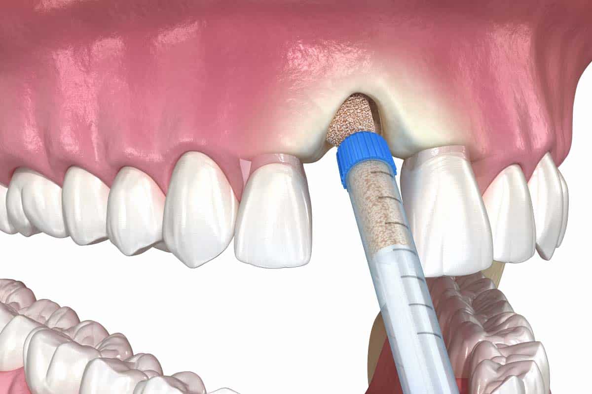Dental Bone Graft in Singapore What is Bone Grafting? Pristine